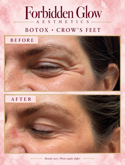 Before and after Botox for crow's feet