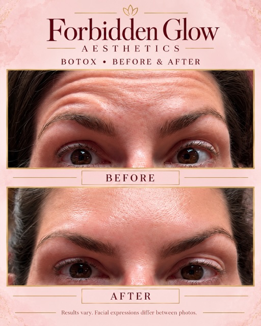 Before and after Botox for forehead lines