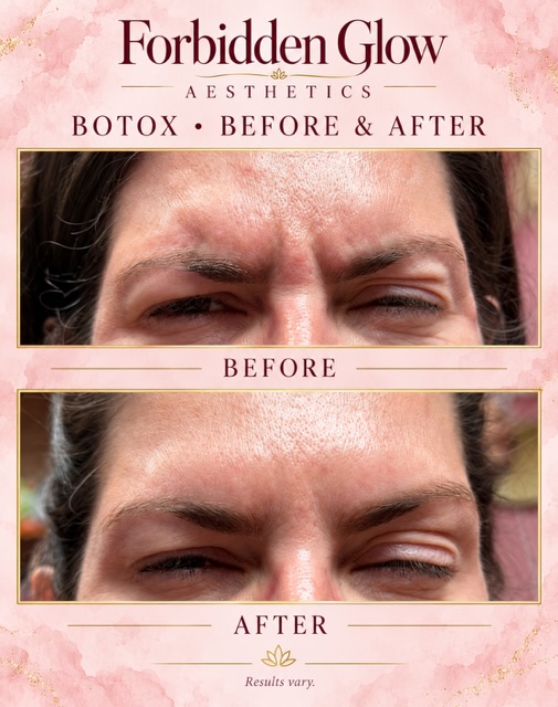 Before and after Botox for frown lines between the brows