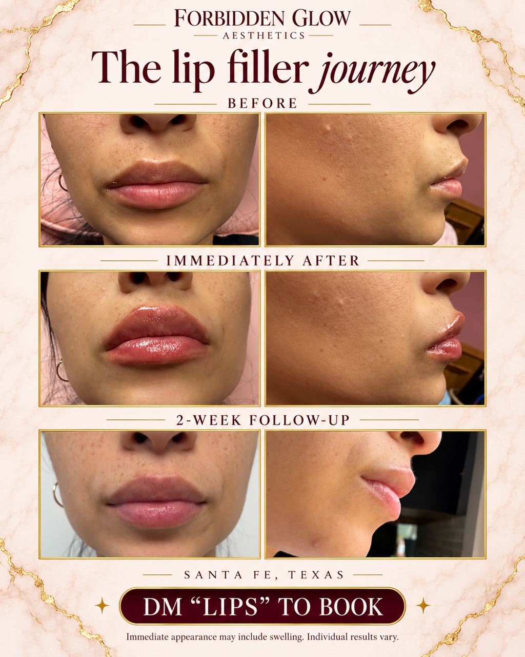 Lip filler before, immediately after, and at a two-week follow-up, front and side views